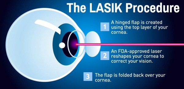 How Lasik Works By Re Shaping Your Cornea